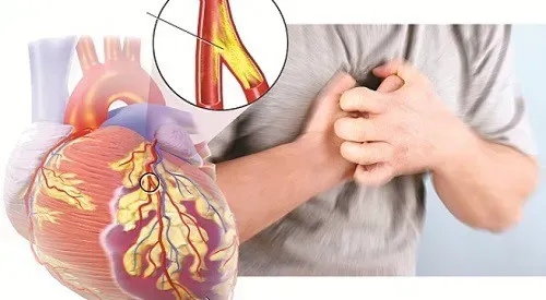 Quấn nóng có giảm mỡ bụng không? Sự thật cần biết 9467